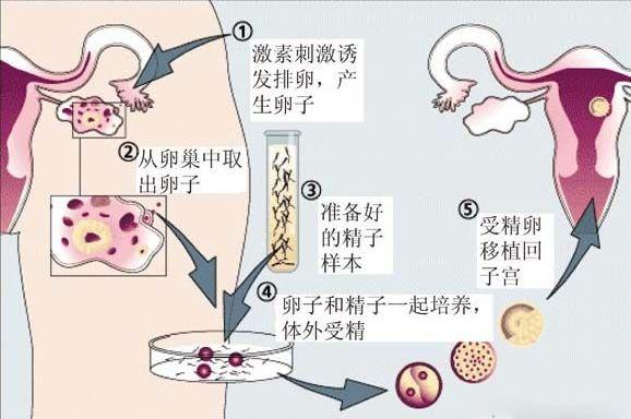 哪里有借卵试管代怀【哪里可以找到借卵试管代怀服务?】